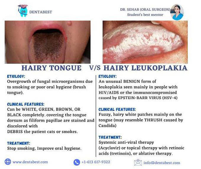 Hairy tongue vs hairy leukoplakia medizzy