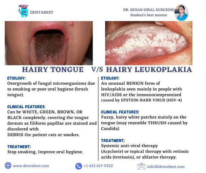 Hairy Tongue vs Hairy Leukoplakia