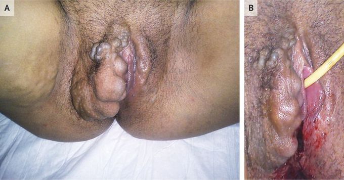 Severe Vulvovaginal Varicosities in Pregnancy