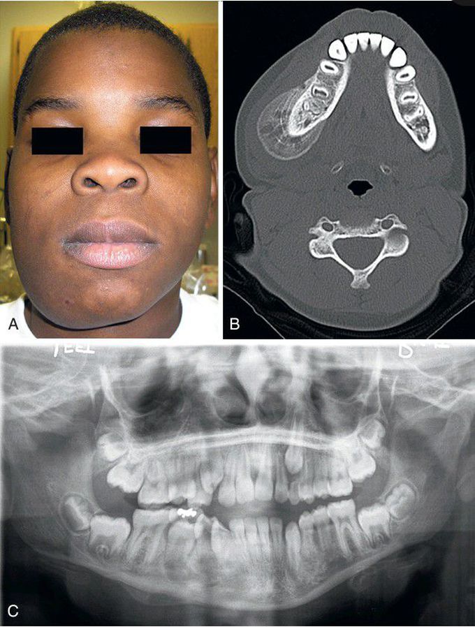 Proliferative Periostitis.