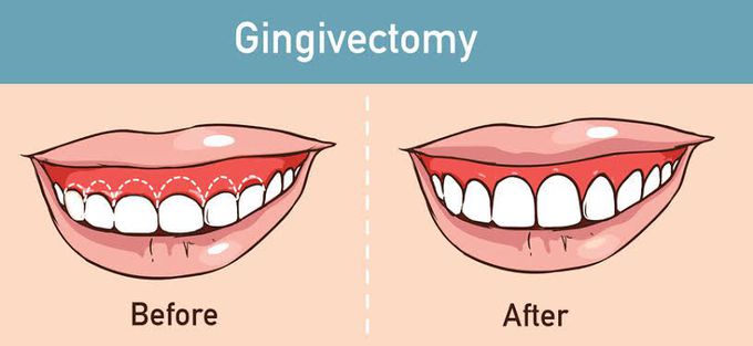 Gingivectomy