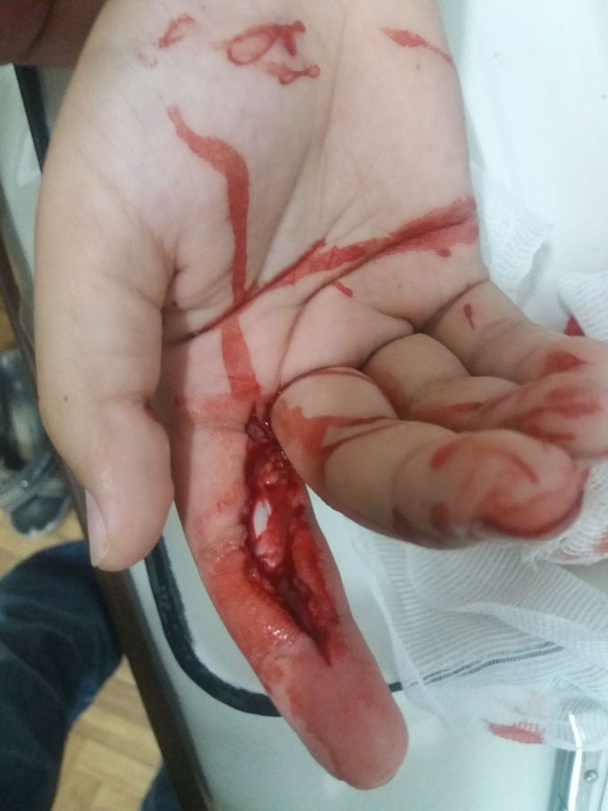 Injury of index