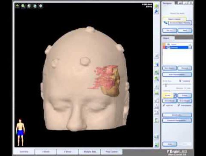 Removal of Brain Tumor: Meningioma (brain surgery)