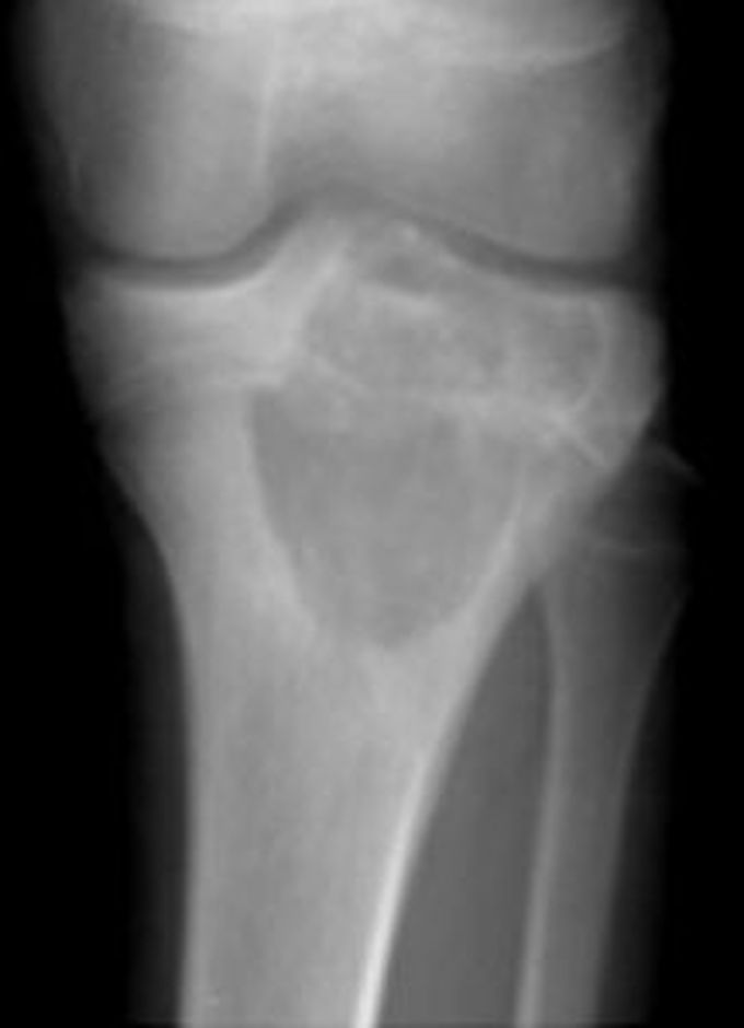 Symptoms of chondroblastoma