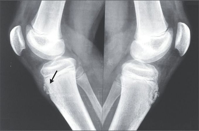 Osgood–Schlatter Disease