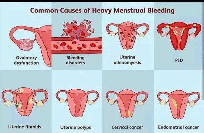 Heavy menstrual bleeding causes.