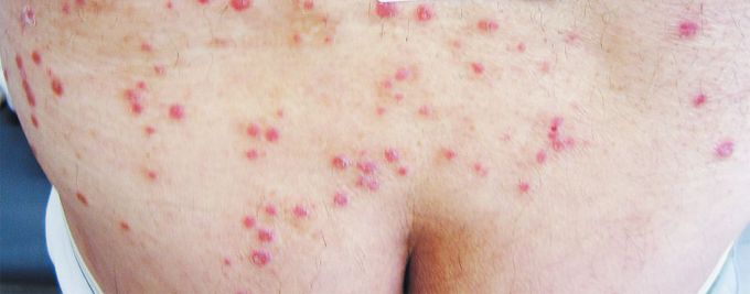 Psoriasis Flare from Koebner's Phenomenon after Acupuncture