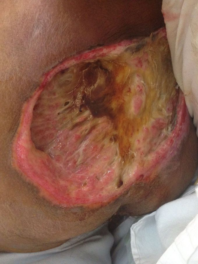 bedsore after necrectomy