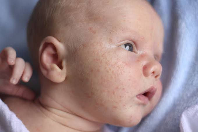 Treatment of baby acne