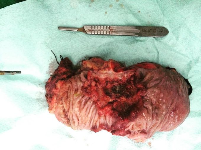 Rectal tumor