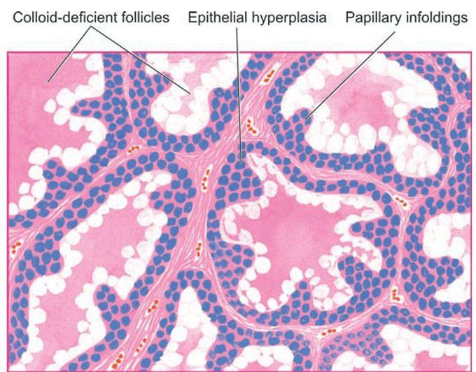 Graves’ disease.