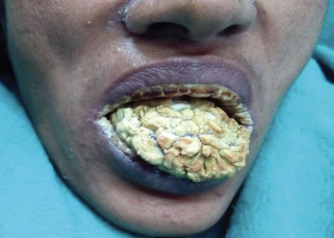 Severe hyperplastic oral candidiasis in a patient with HIV