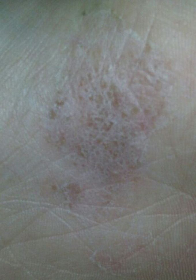 Dermatology