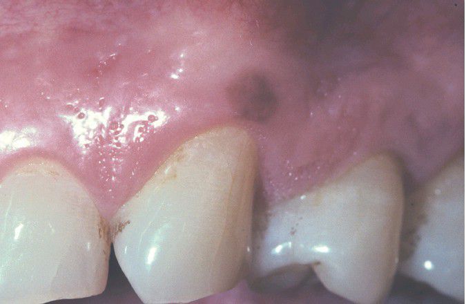 oral melanotic macule treatment at home Oral Melanotic Macule