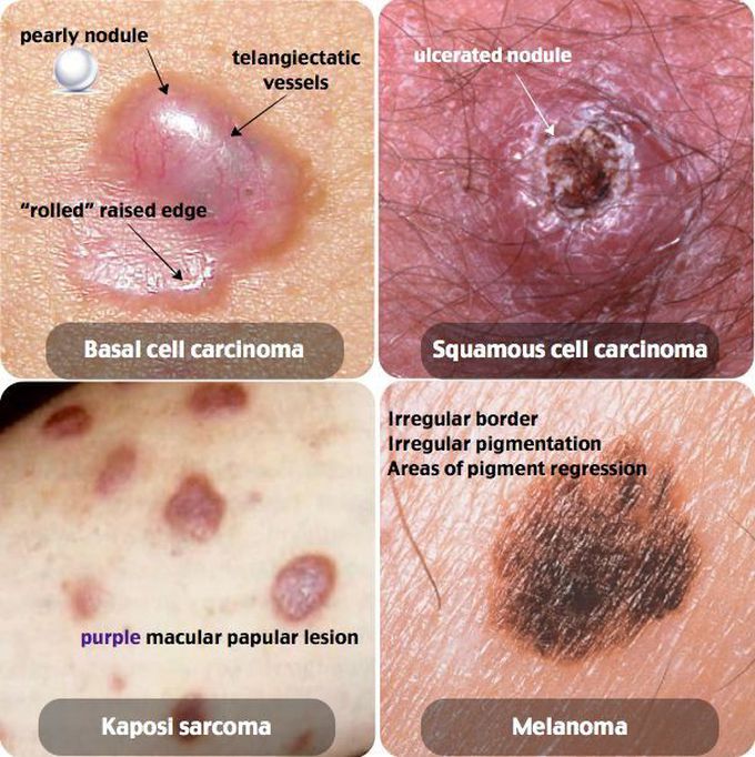 Types of skin carcinoma