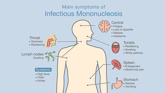 Infectious mononucleosis