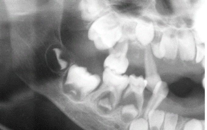 Cyclic Neutropenia.