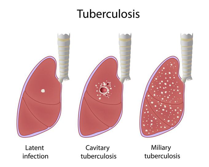 TB types