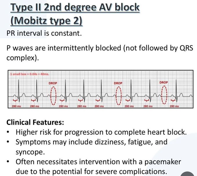 Heart Block VI