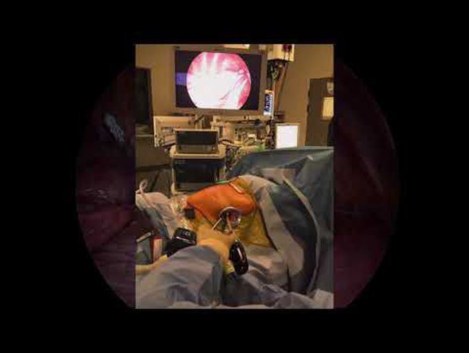 Subxiphoid Uniportal Lung Volume Reduction Surgery