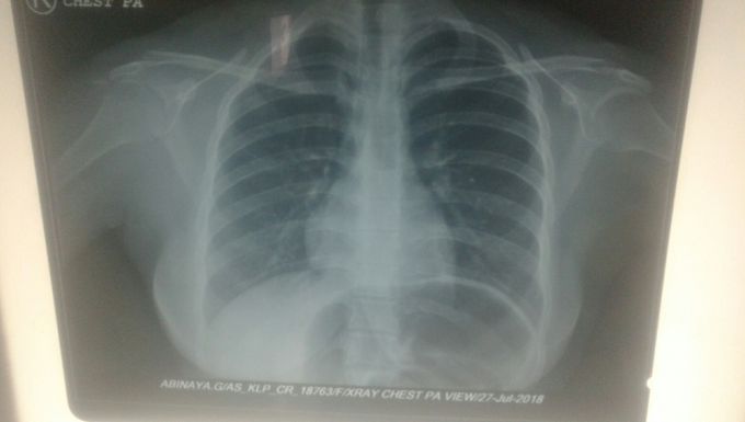 Chest x ray any asking interpretation 