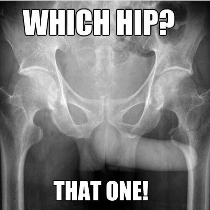 Which hip is broken? That one!😂