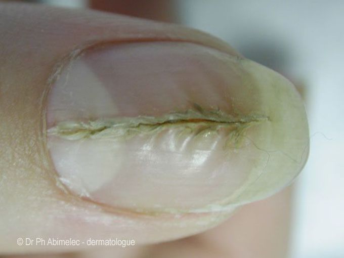 Median Canaliform Nail Dystrophy - MEDizzy