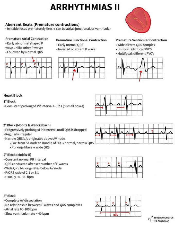 Arrhythmias II