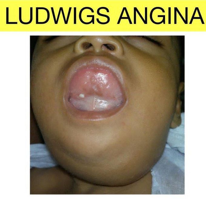 Lugwigs Angina