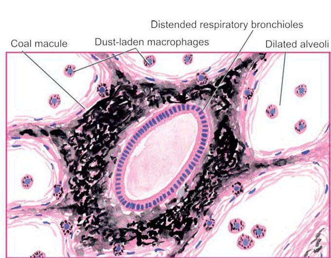 Anthracosis lung.