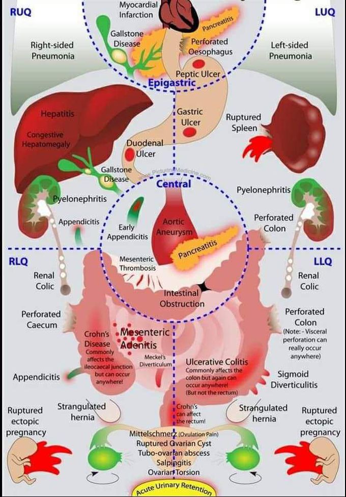 Abdominal pain