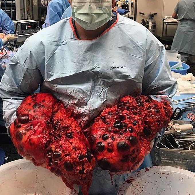 Biggest polycystic kidneys on earth!!! 