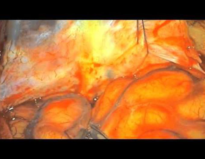 Intracranial blister aneurysms: clip reconstruction techniques