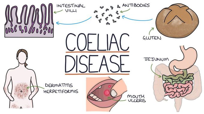 Coeliac dsease