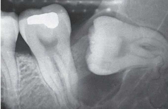 Dentigerous cyst xray