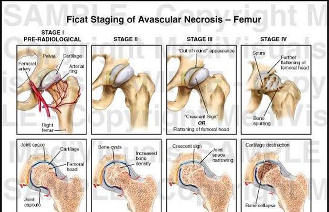 Stages of avascular necrosis of femur