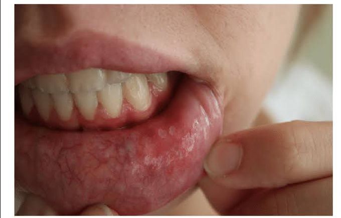 Minor aphthae