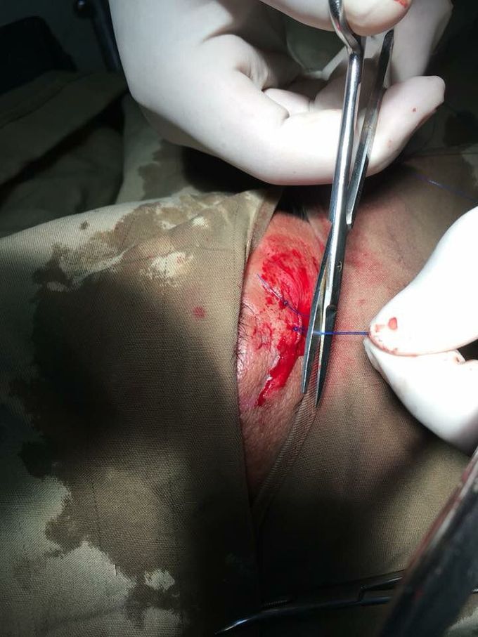 Suturing