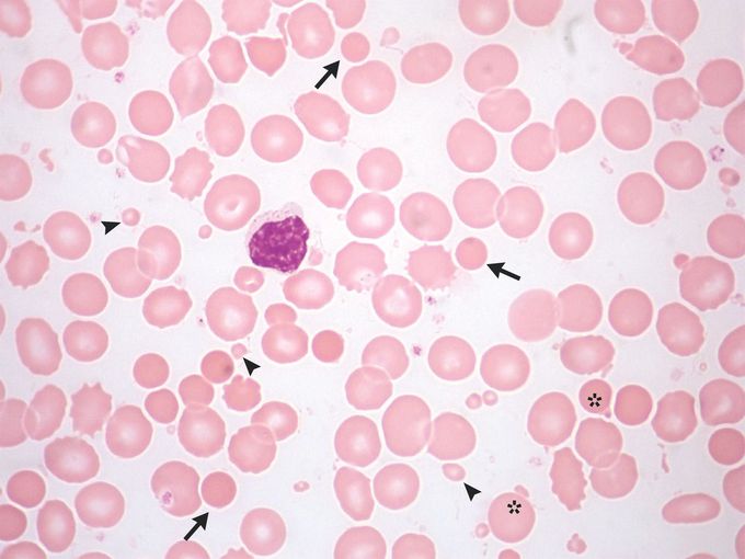 Pseudothrombocytosis