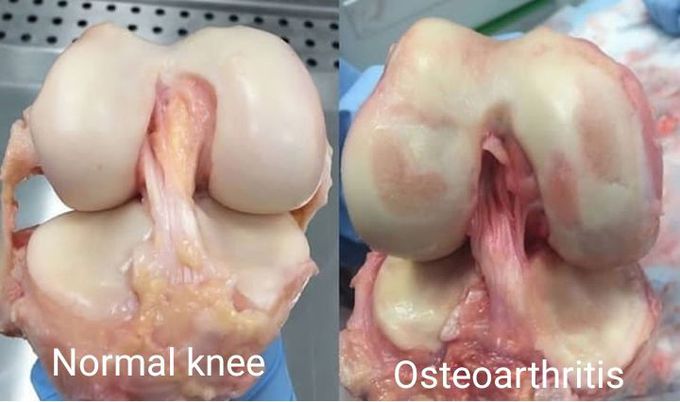Osteoarthritis