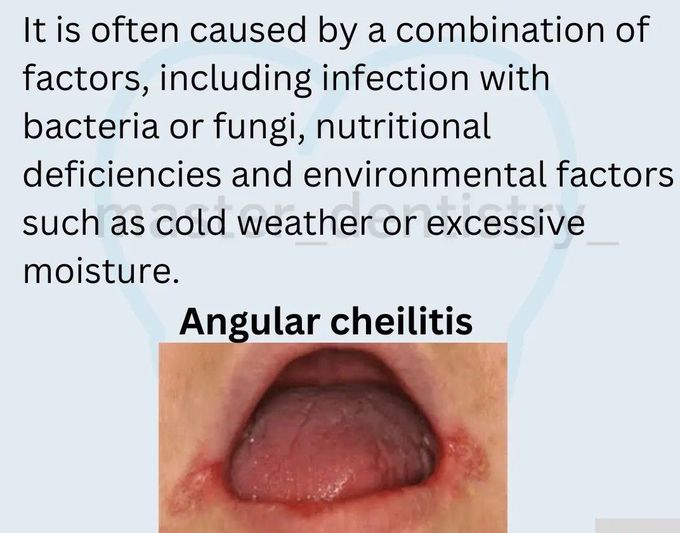 Angular Cheilitis