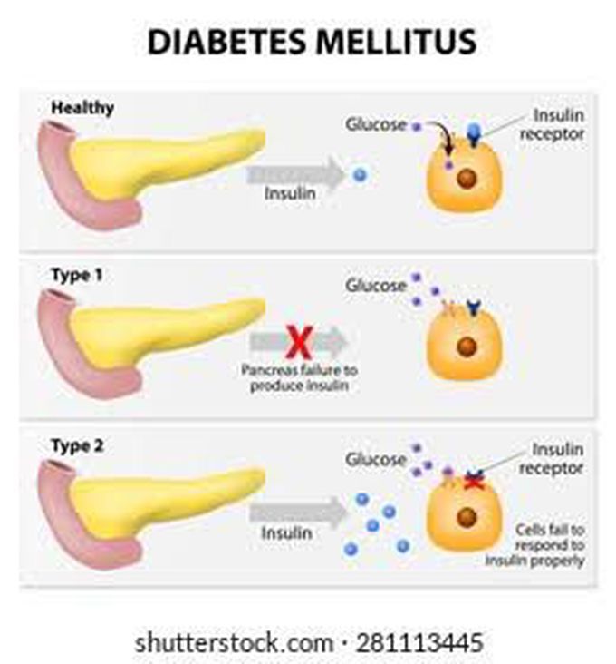 Diabetes mellitus