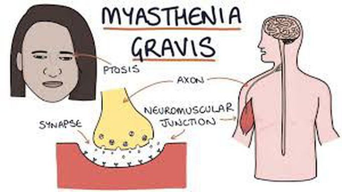 Complications of myasthenia