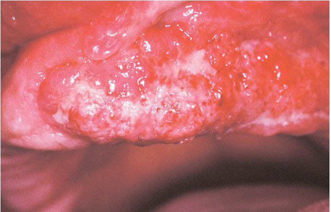 Paracoccidioidomycosis