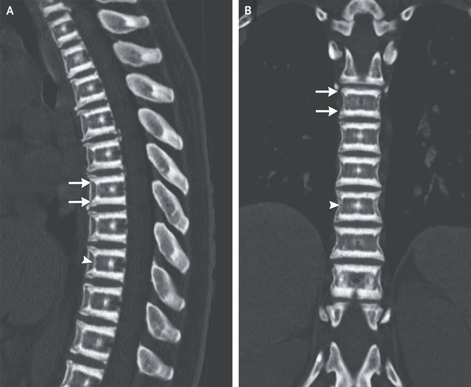 Autosomal Dominant Osteopetrosis