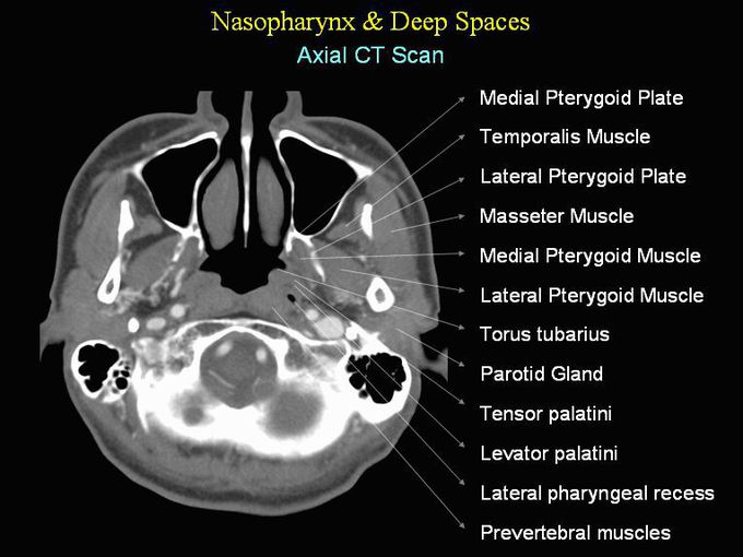 Nasopharynx & deep spaces in the axial CT scan