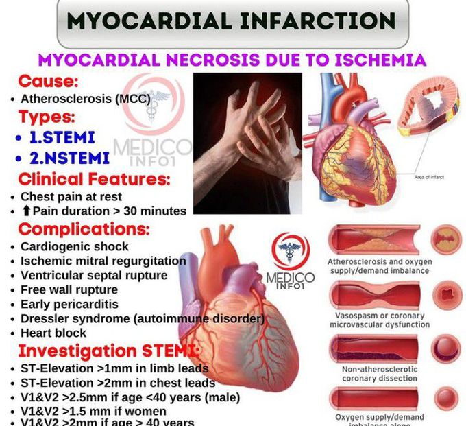 duration of pain in myocardial infarction        <h3 class=