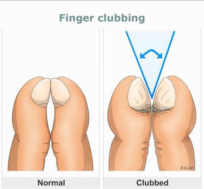 Finger clubbing