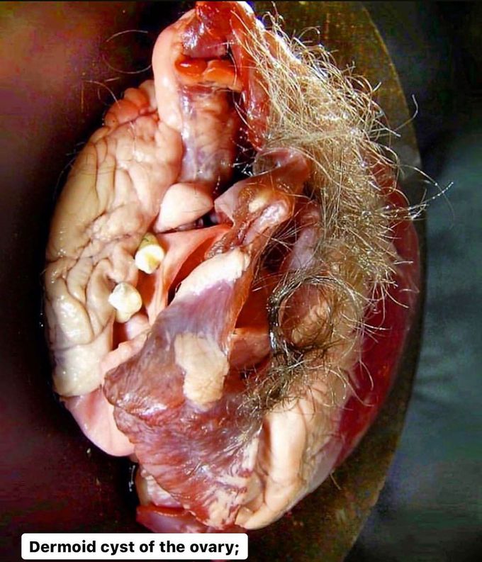 Teratoma