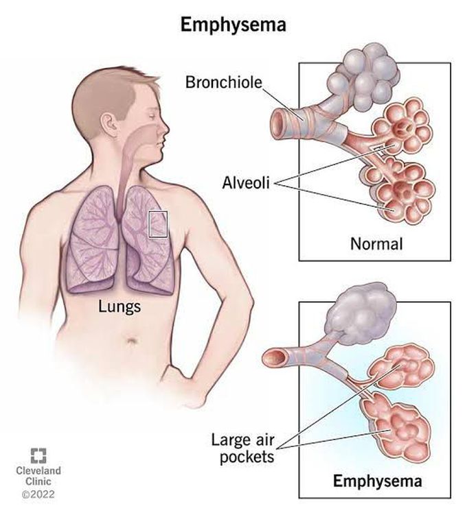 Symptoms of emphysema